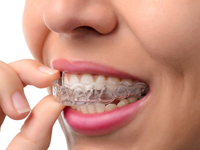 The image shows a person with an orthodontic appliance, specifically a clear aligner, placed over their teeth.