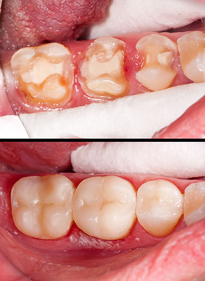 The image shows a close-up of an open mouth with teeth that appear to be in poor condition, specifically with cavities and discoloration.