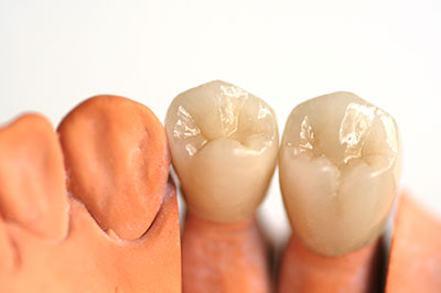 Dental implants with a focus on the natural-looking gumline and teeth.