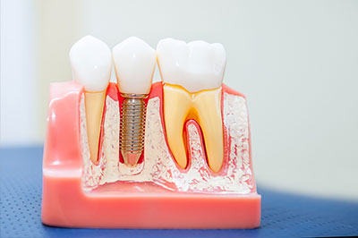 An image of a dental model with teeth and gums, featuring a close-up view of various dental parts such as crowns, implants, and a screw, showcasing the components used in dental procedures.