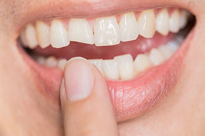 An individual s smiling mouth with a white filling, focusing on dental care or oral health.