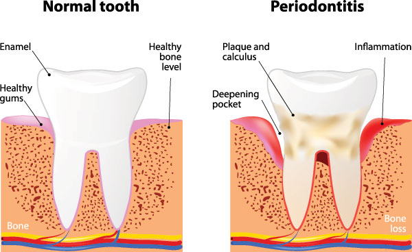 The image is a medical illustration showing the stages of tooth decay, from normal to periodontitis, with annotations indicating the progression and symptoms.