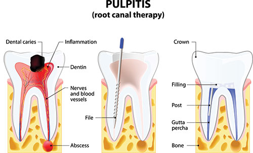 The image shows a diagrammatic representation of the pulpitis process in teeth, with labels indicating different stages and structures, such as dental caries, inflammation, and a toothbrush. It s an educational illustration meant to explain dental health issues.