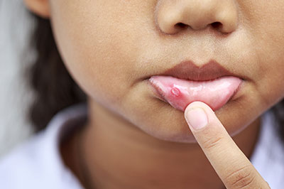 The image shows a young individual with an acne-covered face, pointing to their skin with one finger.