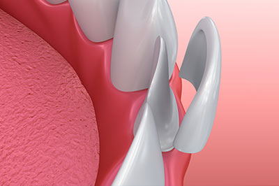 The image depicts a close-up view of a dental implant with visible screws and a pink gum tissue background.