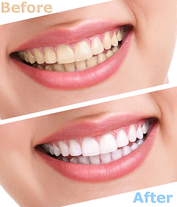 The image displays a before-and-after comparison of teeth whitening, featuring a woman s smile with noticeable tooth whiteness enhancement.