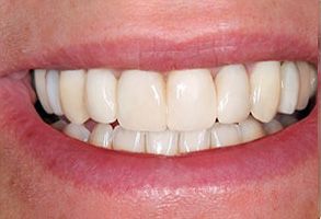 The image displays a close-up of a person s smiling face with a focus on their teeth, which are straight and white.