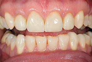 Image of a person s mouth with a set of yellowed teeth, showcasing dental discoloration.
