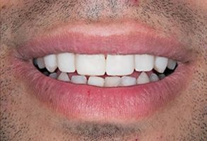 The image shows a person with a full set of teeth, smiling broadly.