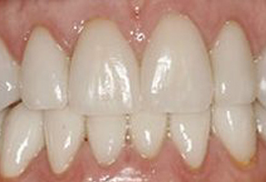 Image of a person s teeth with visible signs of wear and discoloration, showcasing the need for dental care.