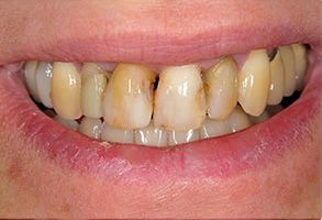 The image depicts a close-up of a person s mouth with visible dental work, including yellowed teeth and a partial denture.