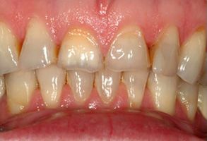 This is an image of a person s teeth with visible yellowing, suggesting possible dental issues or the need for professional cleaning.